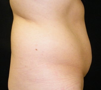 CoolSculpting 965303