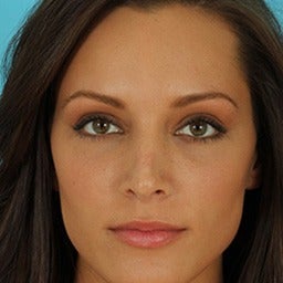Revision Rhinoplasty after 1675652