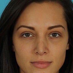 Revision Rhinoplasty before 1675652