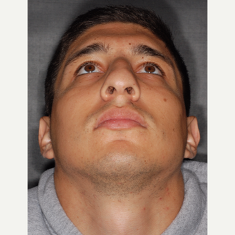 25-34 year old man treated with Septoplasty 3 years post-op before 3814067