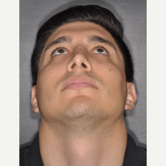 25-34 year old man treated with Septoplasty 3 years post-op after 3814067