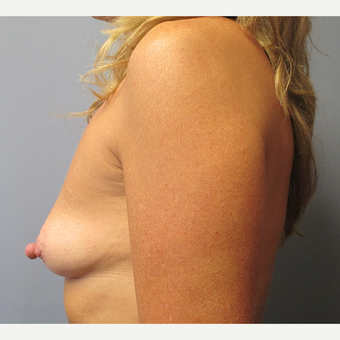 45-54 year old woman treated with Breast Augmentation before 3538901