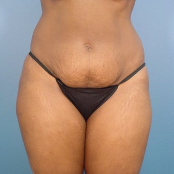 35-44 year old woman treated with Tummy Tuck before 1980382