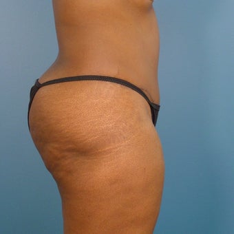 35-44 year old woman treated with Tummy Tuck 1980382