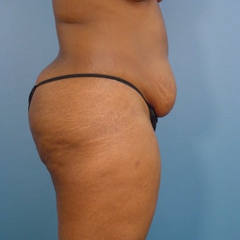 35-44 year old woman treated with Tummy Tuck 1980382
