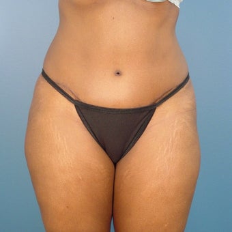 35-44 year old woman treated with Tummy Tuck after 1980382