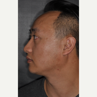 35-44 year old man treated with Septoplasty 8 months post-op after 3500039