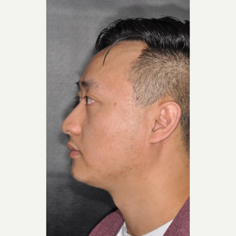 35-44 year old man treated with Septoplasty 8 months post-op before 3500039