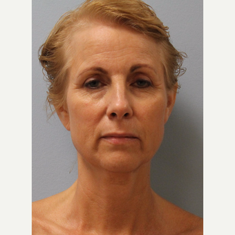 65-74 year old woman treated with Facelift before 3615741