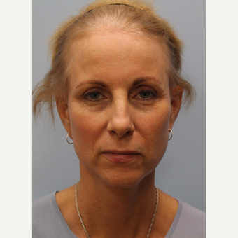 65-74 year old woman treated with Facelift after 3615741