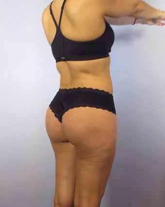 Brazilian Butt Lift after 1314164