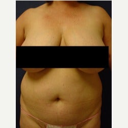 45-54 year old woman treated with Mini Tummy Tuck before 2058550