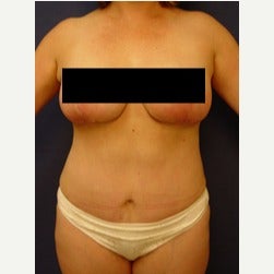 45-54 year old woman treated with Mini Tummy Tuck after 2058550
