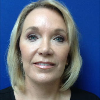 45-54 year old woman treated with Facelift after 3326237