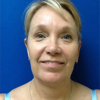 45-54 year old woman treated with Facelift before 3326237