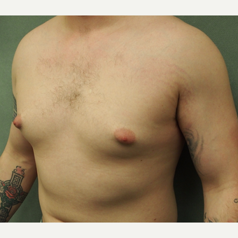 18-24 year old man treated with Male Breast Reduction before 3743542