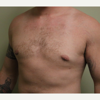 18-24 year old man treated with Male Breast Reduction after 3743542