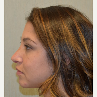 18-24 year old woman treated with Nose Surgery after 3408523