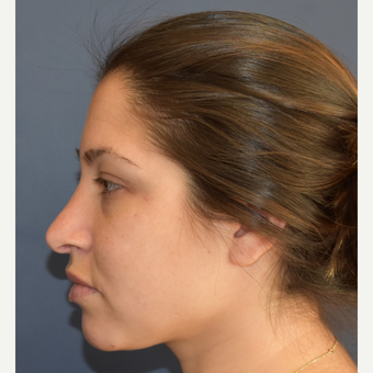 18-24 year old woman treated with Nose Surgery before 3408523