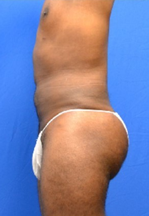 34 Year Old Male, Brazilian Butt Lift after 1498156
