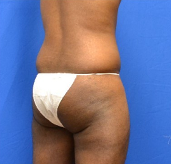 34 Year Old Male, Brazilian Butt Lift 1498156