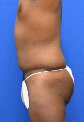 34 Year Old Male, Brazilian Butt Lift before 1498156