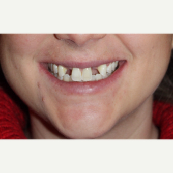22 year old female with 2 dental implants with eMax crowns and 8 eMax veneers. before 3126687