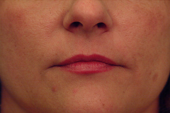 Injectable Filler before 149357