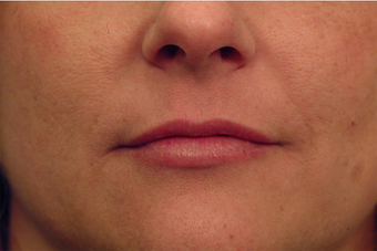 Injectable Filler after 149357