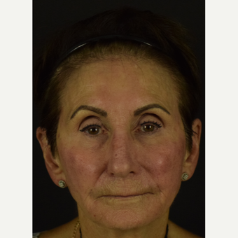 NovaLift with PDO Threads for Non-Surgical Rejuvenation after 3793559