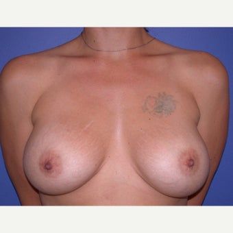 Breast Implant Revision before 1686822