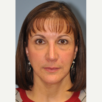 45-54 year old woman treated with Revision Rhinoplasty after 3332457