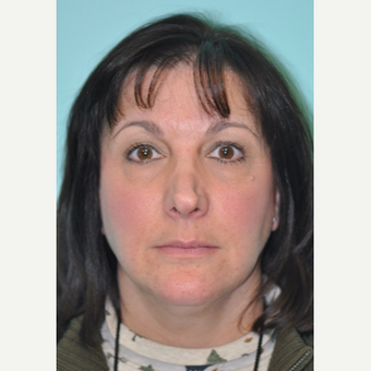 45-54 year old woman treated with Revision Rhinoplasty before 3332457