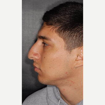 25-34 year old man treated with Nose Surgery 3 years post-op before 3814080
