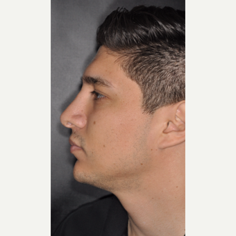 25-34 year old man treated with Nose Surgery 3 years post-op after 3814080