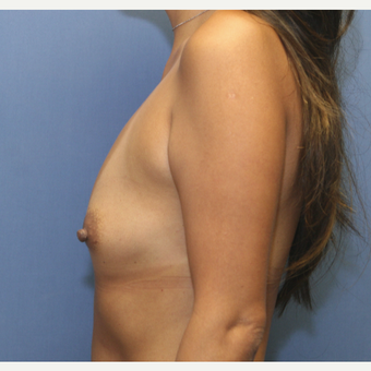 35-44 year old woman treated with Breast Augmentation before 3524526