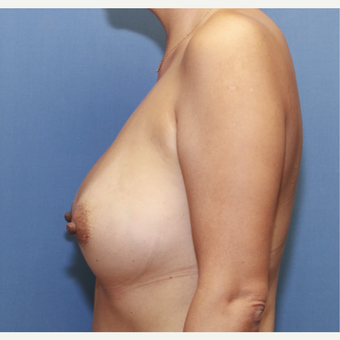 35-44 year old woman treated with Breast Augmentation after 3524526