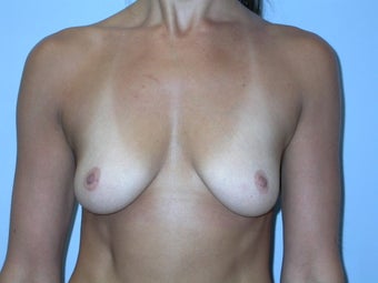 Breast Augmentation 500 cc Silicone Implants before 90238
