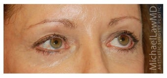 Eye Bag Treatment after 1256433