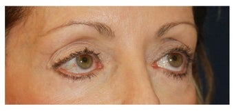 Eye Bag Treatment before 1256433