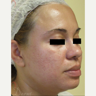 25-34 year old woman treated with Fractional CO2 Laser after 3375115