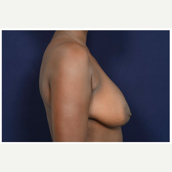 35-44 year old woman treated with Breast Reduction before 3174586