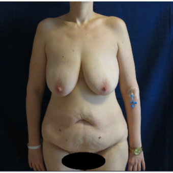 45-54 year old woman treated with Mommy Makeover before 3796855