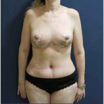 45-54 year old woman treated with Mommy Makeover after 3796855