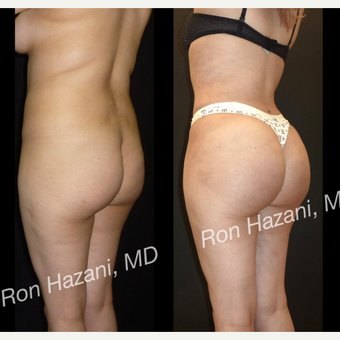 18-24 year old woman treated with Brazilian Butt Lift before 3680269