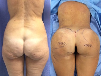 BBL in a 54 Year Old Patient With Sagging Buttocks before 1511898
