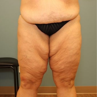 45-54 year old woman requesting Thigh Lift before 3455521