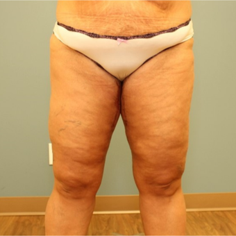 45-54 year old woman requesting Thigh Lift after 3455521