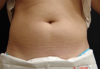 Coolsculpting Abdomen after 344044