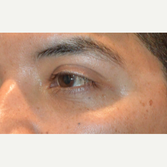 Lower blepharoplasty after 3248034
